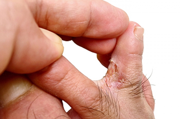 The patient's hands and feet (A) Tinea pedis on the fifth toe of the